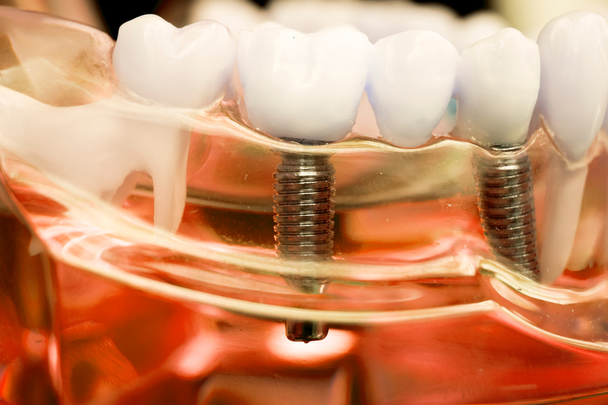 Dentist Dental Teeth Implant